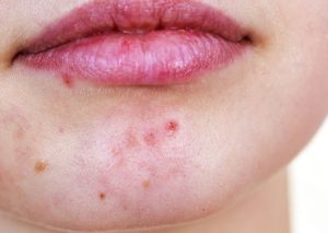 žena čisti bradu i smiruje hormonske bubuljice