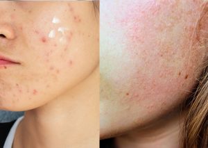 razlika između purging efekta i reakcije kože