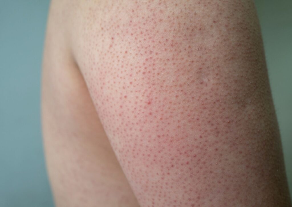 keratoza pilaris guščija koža na nadlakticama