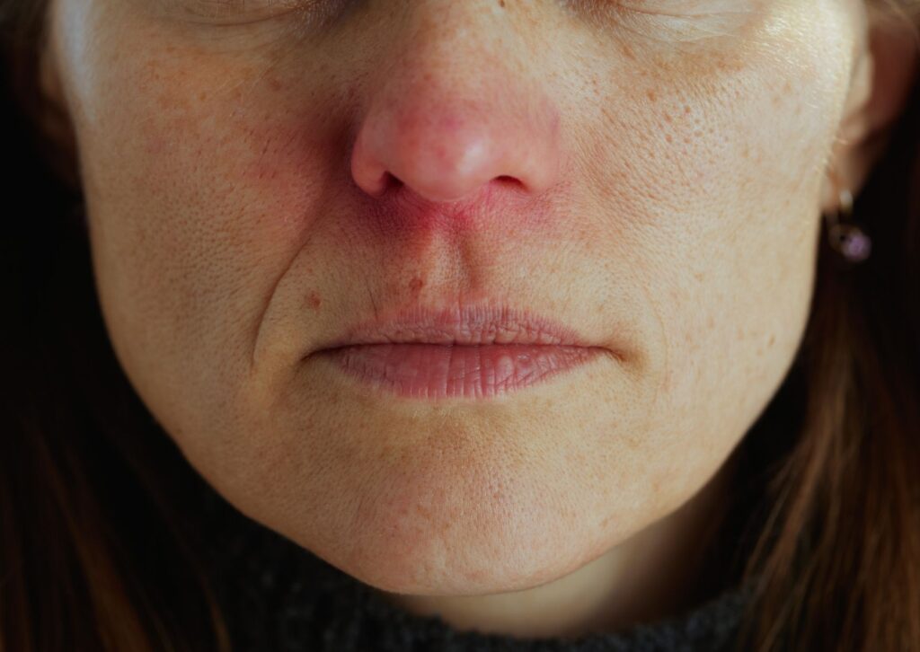 seborrheic dermatitis facial redness and peeling of the skin